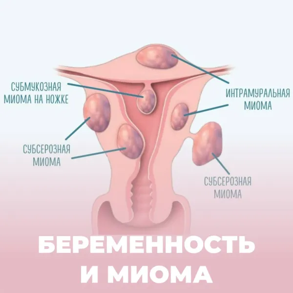 Можно ли беременеть с миомой матки?